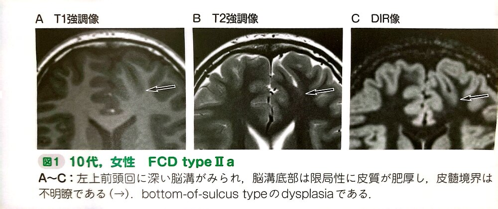 FCD MRI