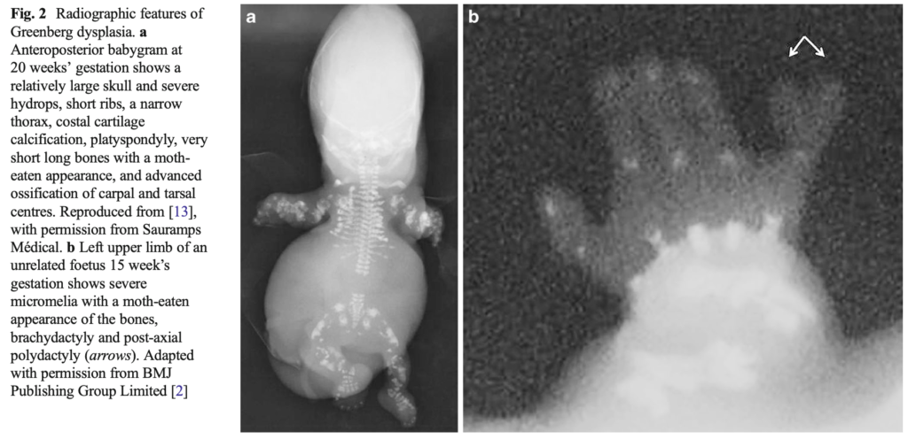 点状軟骨異形成症(chondrodysplasia punctata)
case1,2
