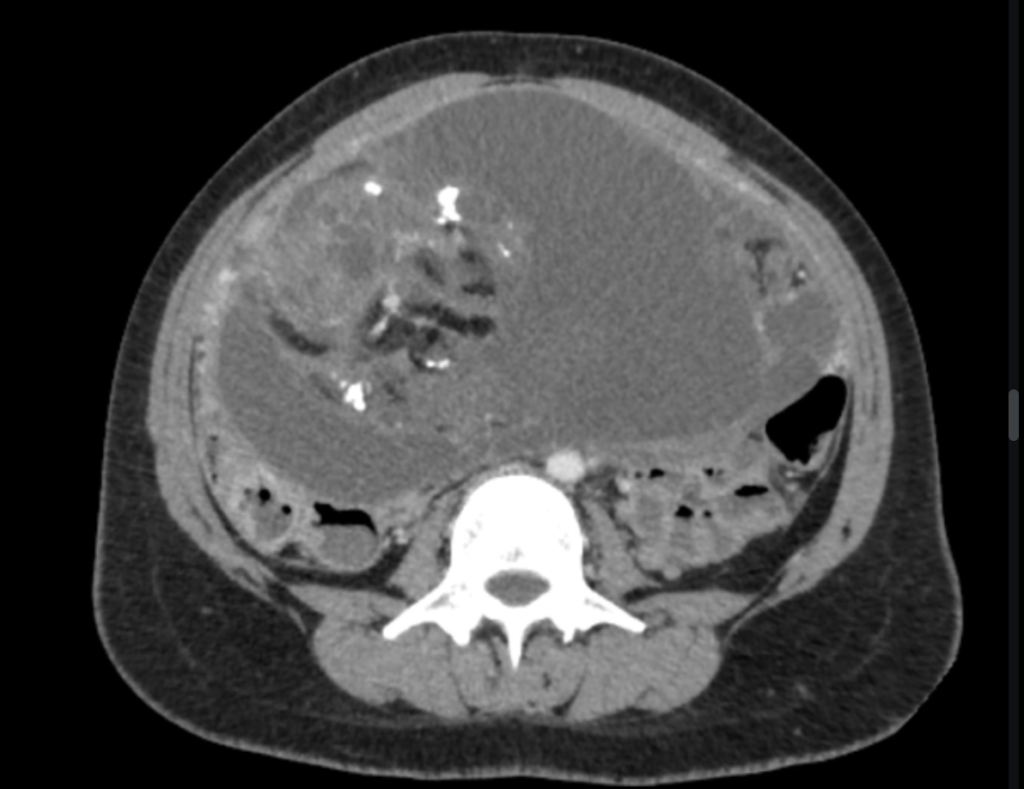 immature ovarian teratoma
case3