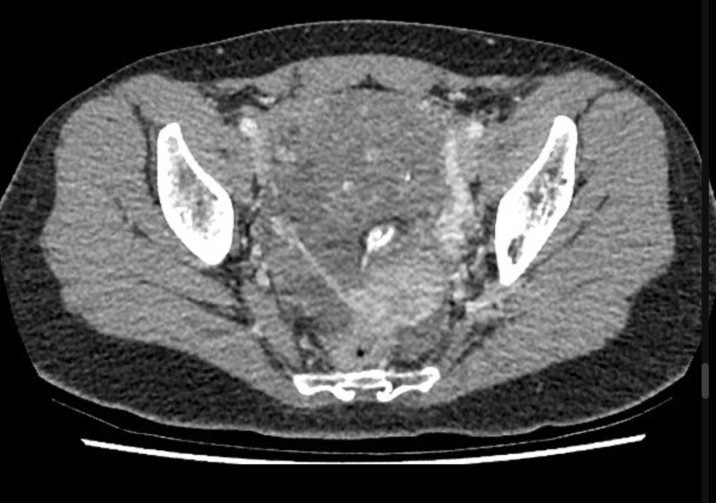 immature ovarian teratoma
case4
