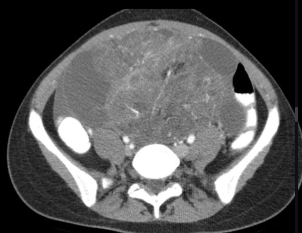 immature ovarian teratoma
case5