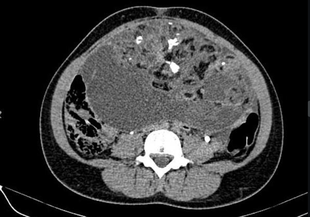 immature ovarian teratoma
case6
