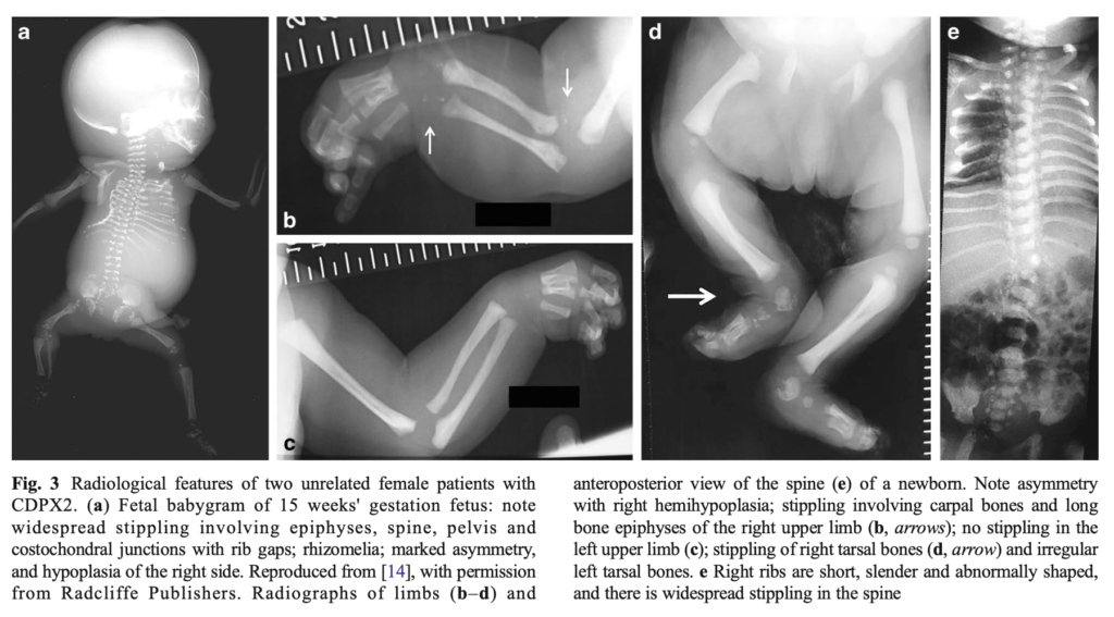 点状軟骨異形成症(chondrodysplasia punctata)
case3
