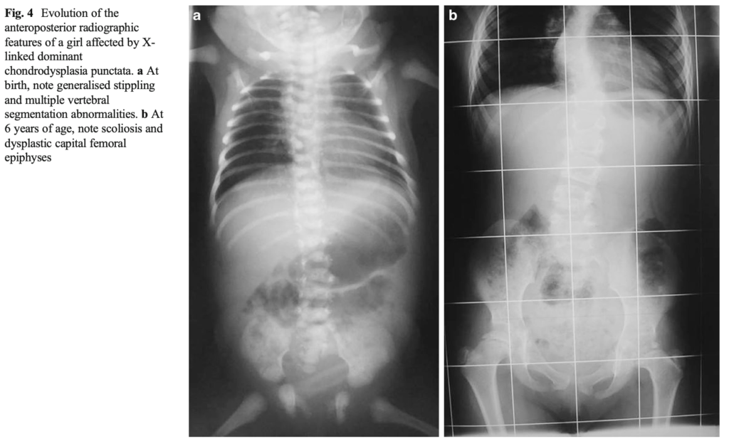 点状軟骨異形成症(chondrodysplasia punctata)
case4