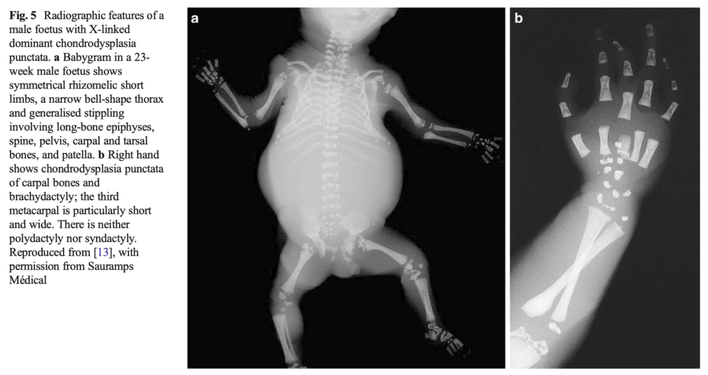 点状軟骨異形成症(chondrodysplasia punctata)
case5