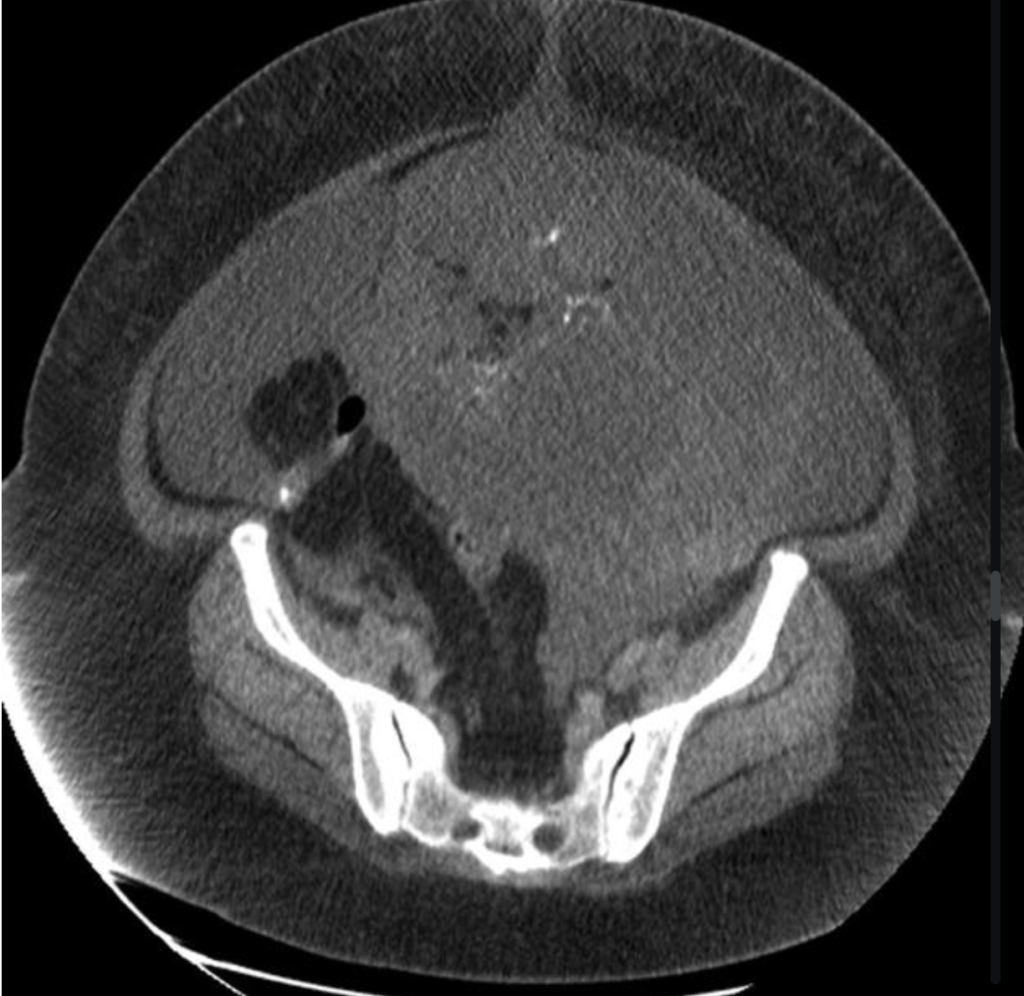 immature ovarian teratoma
case1