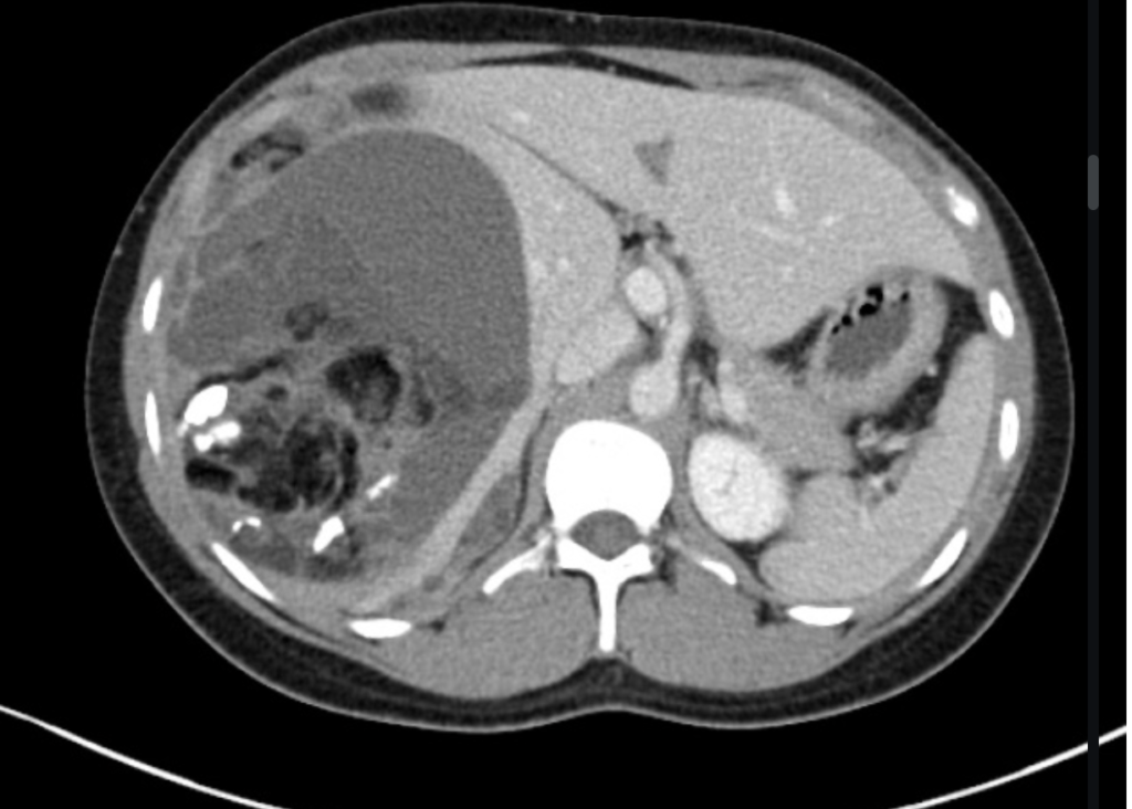 immature ovarian teratoma
case2